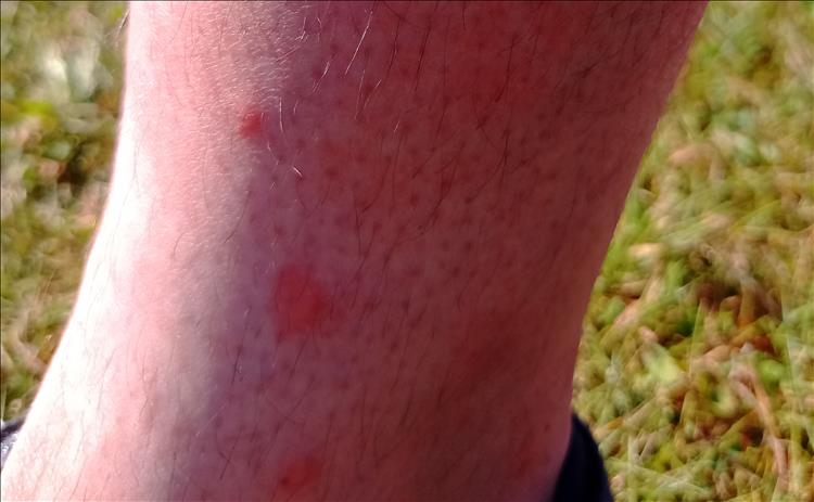 Ren's lower leg with 3 or 4 red marks from the midge bites