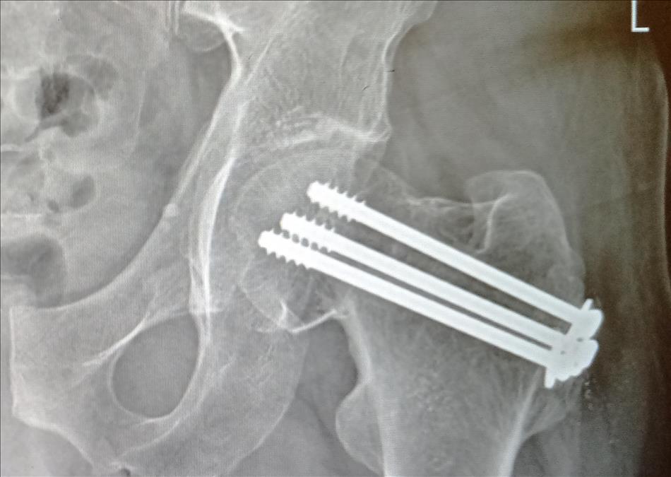 X ray showing 3 screws with washers in a hip joint